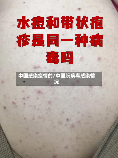 中国感染疫情的/中国朊病毒感染情况-第3张图片